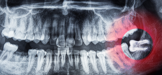 problemātiski izauguša gudrības zoba rentgens